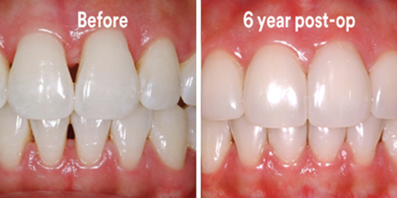 BioClear Diastema Closure and Black Triangle Closure  - Farrell Dental, Lockport Dentist