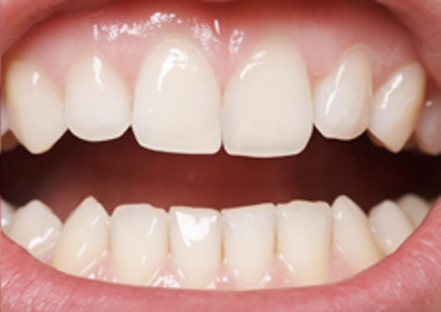 Cosmetic Bonding  - Farrell Dental, Lockport Dentist