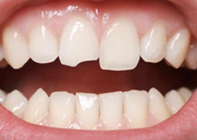 Cosmetic Bonding  - Farrell Dental, Lockport Dentist