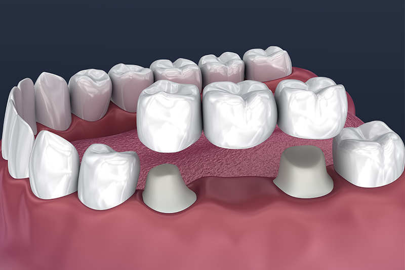 Crowns and Bridges, Inlays and Onlays  - Farrell Dental, Lockport Dentist