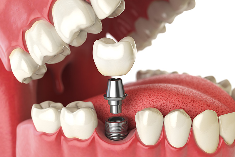 Dental Implants - Farrell Dental, Lockport Dentist