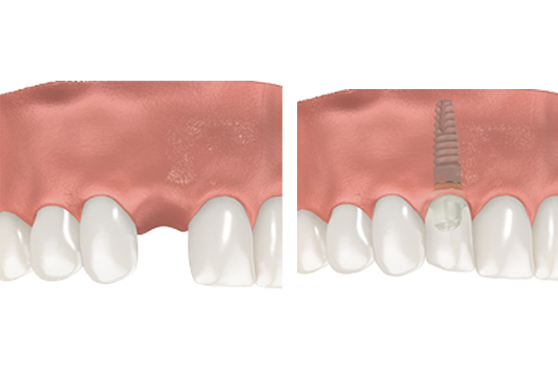 Dental Implants - Farrell Dental, Lockport Dentist