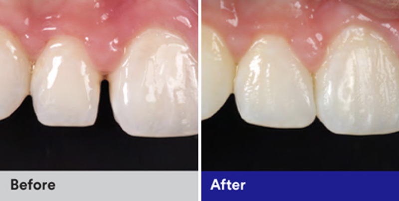 BioClear Diastema Closure and Black Triangle Closure  - Farrell Dental, Lockport Dentist