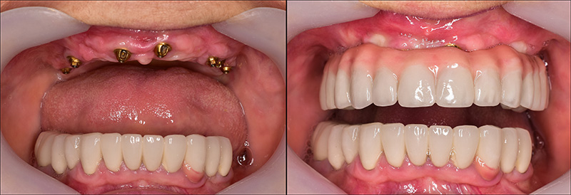 Implant Overdentures and Fixed All-On-X Treatment  - Farrell Dental, Lockport Dentist