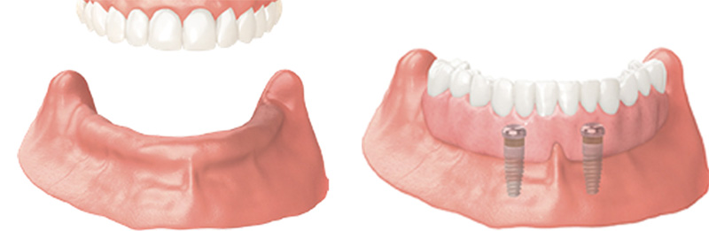 Implant Overdentures and Fixed All-On-X Treatment  - Farrell Dental, Lockport Dentist