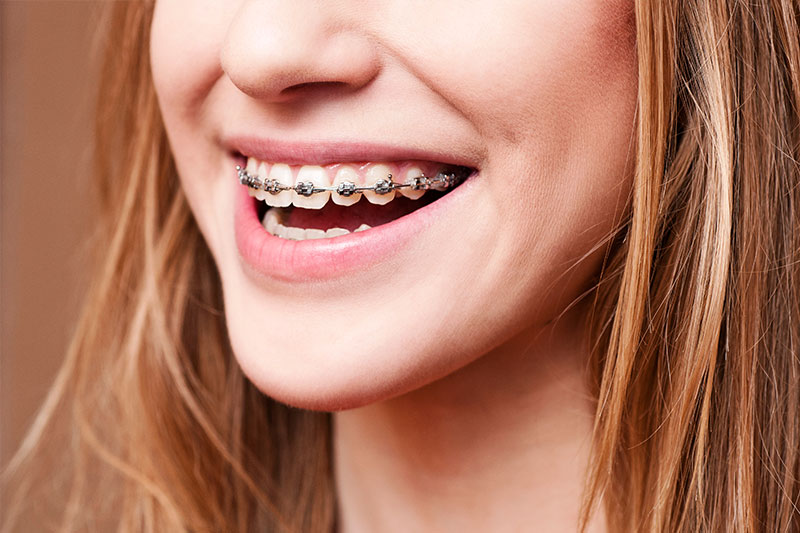 Orthodontics - Farrell Dental, Lockport Dentist