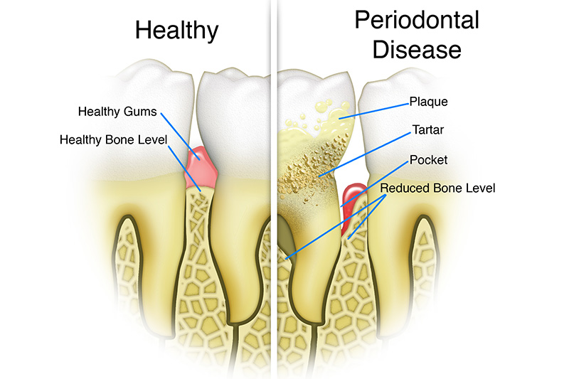 Scaling & Root Planings (Deep Cleanings)  - Farrell Dental, Lockport Dentist