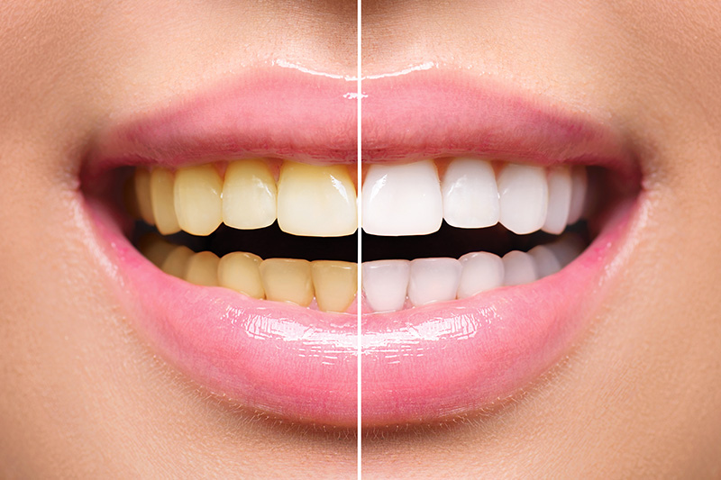 Teeth Whitening - Farrell Dental, Lockport Dentist