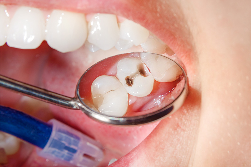 Tooth Colored Composite Fillings  - Farrell Dental, Lockport Dentist