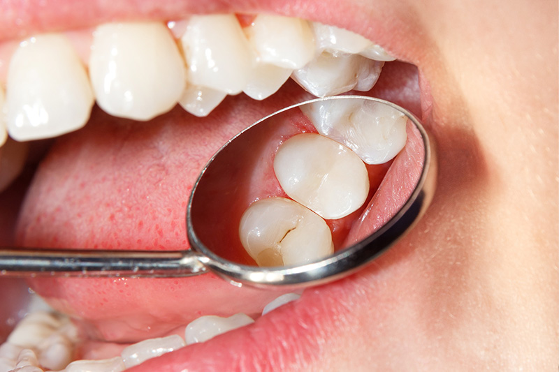 Tooth Colored Composite Fillings  - Farrell Dental, Lockport Dentist