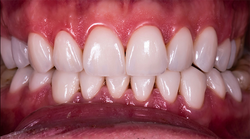 Veneers  - Farrell Dental, Lockport Dentist