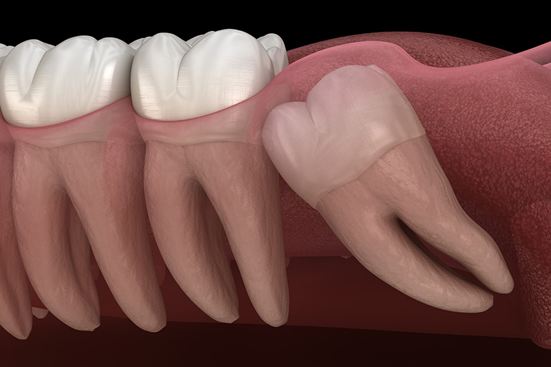 Wisdom Teeth Extractions (with Sedation)  - Farrell Dental, Lockport Dentist